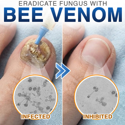 FungiFree Bee Venom Nail Treatment 🐝  Natural Nail & Cuticle Conditioning Care