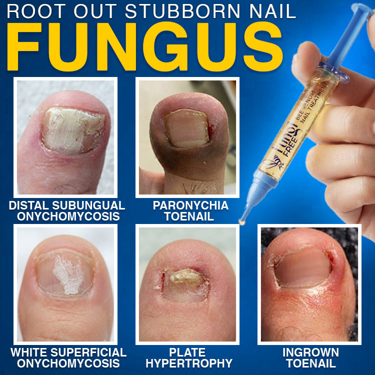 FungiFree Bee Venom Nail Treatment 🐝  Natural Nail & Cuticle Conditioning Care