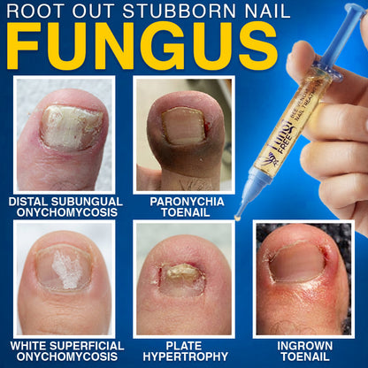 FungiFree Bee Venom Nail Treatment 🐝  Natural Nail & Cuticle Conditioning Care